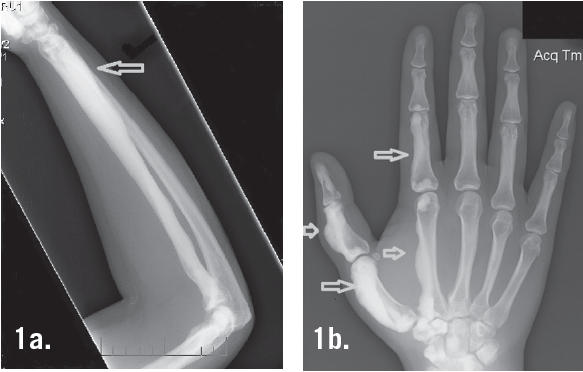 Melorheostosis Consultant360